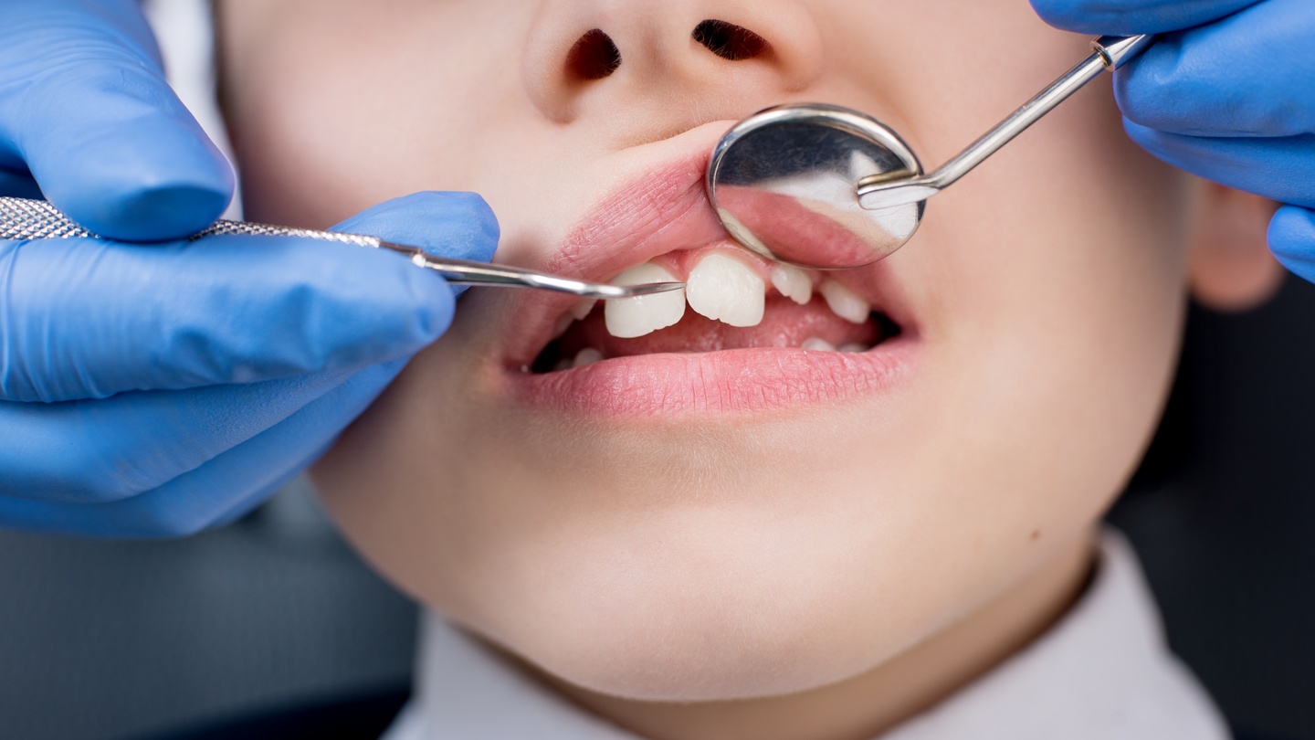 Особенности лечения пульпита временных и постоянных зубов