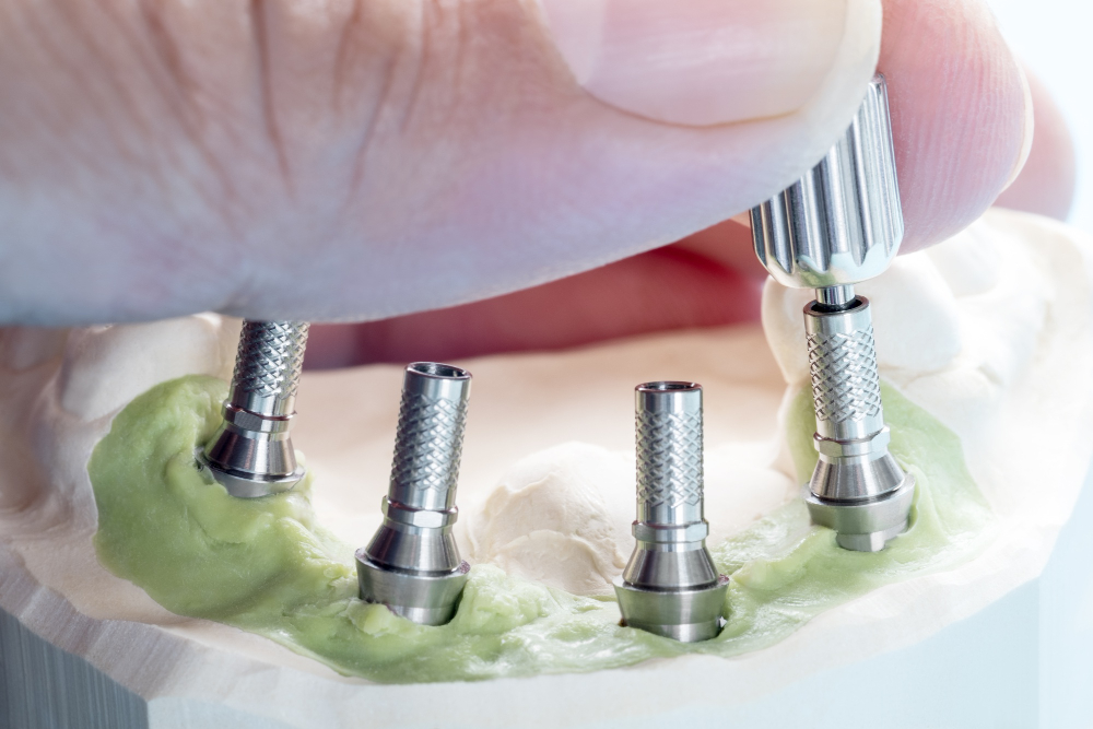 От чего зависят цены на протезирование зубов на 4 имплантах