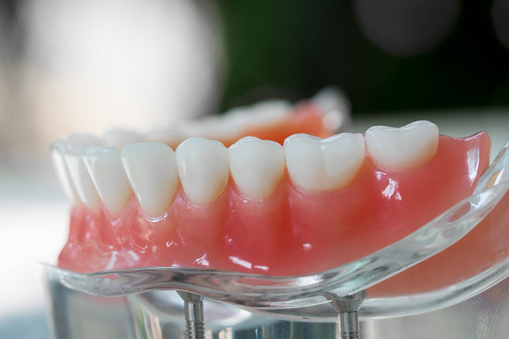 Особенности протезирования на имплантах при полном отсутствии зубов