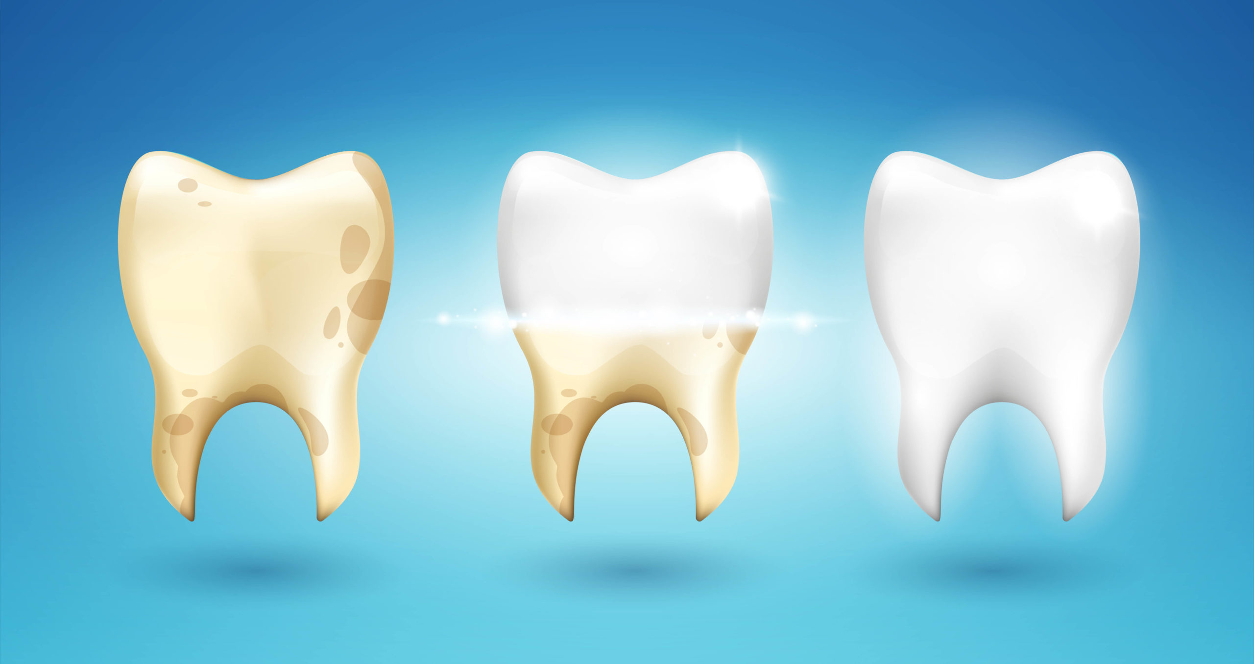 Отбеливание зубов – процедура, которая вернет привлекательную улыбку