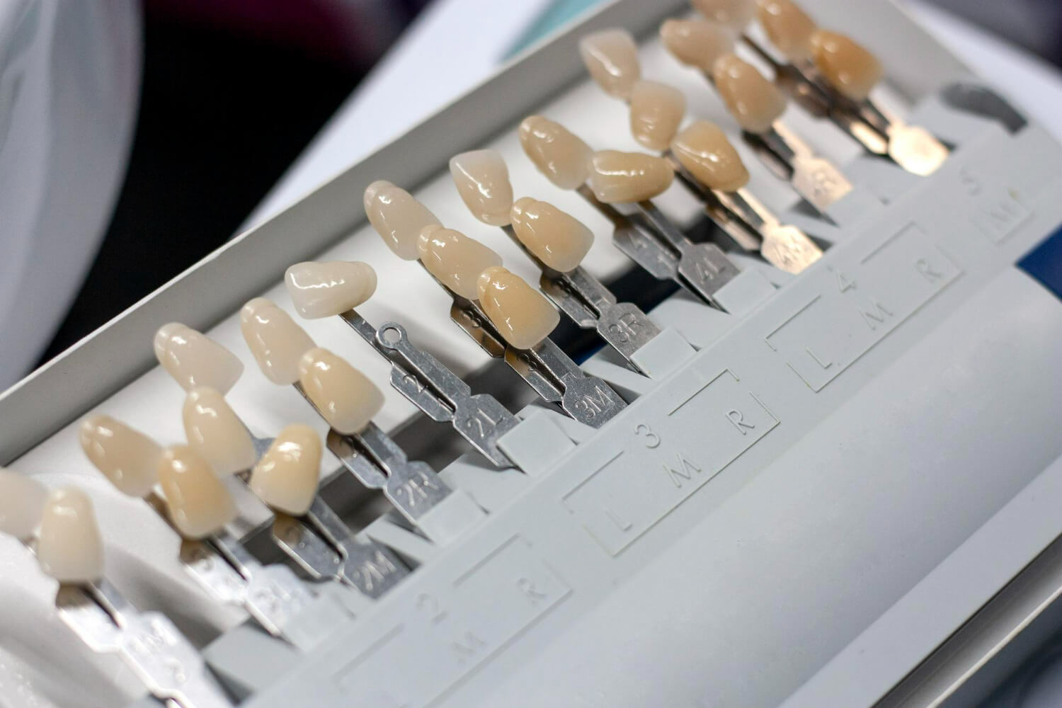 Реставрация передних зубов: варианты и материалы