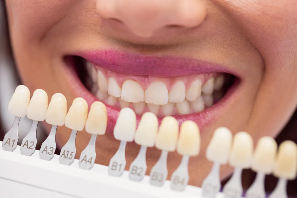 Реставрация зубов – современная услуга для поддержания красоты улыбки
