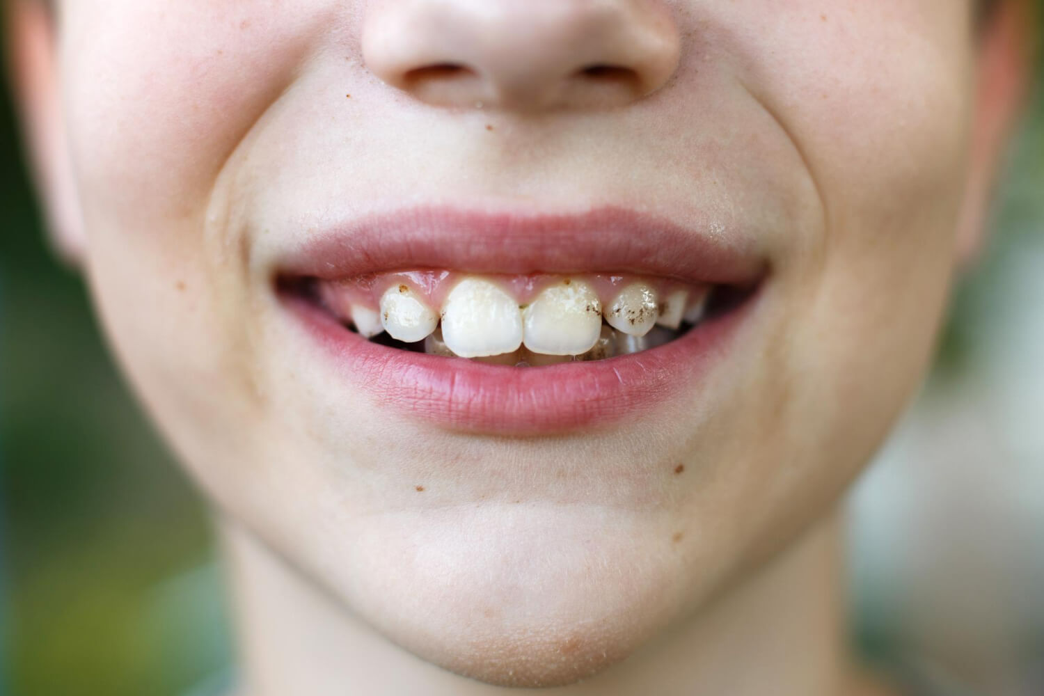Пятна на зубах – что это такое и как от них избавиться