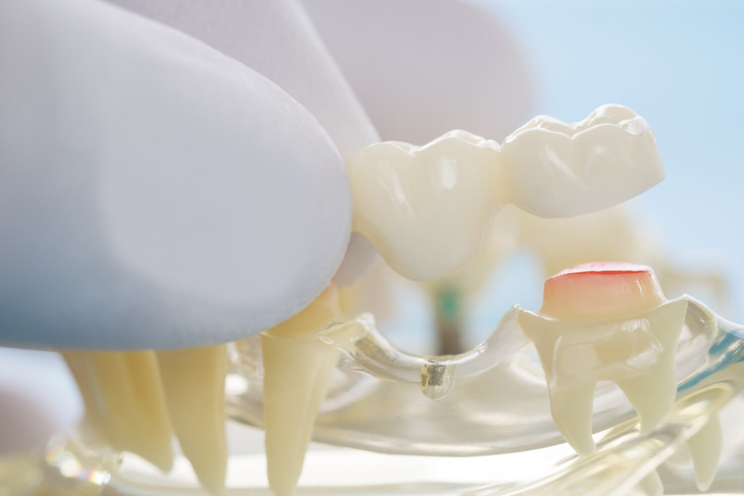Что лучше установить: зубной мост или имплант