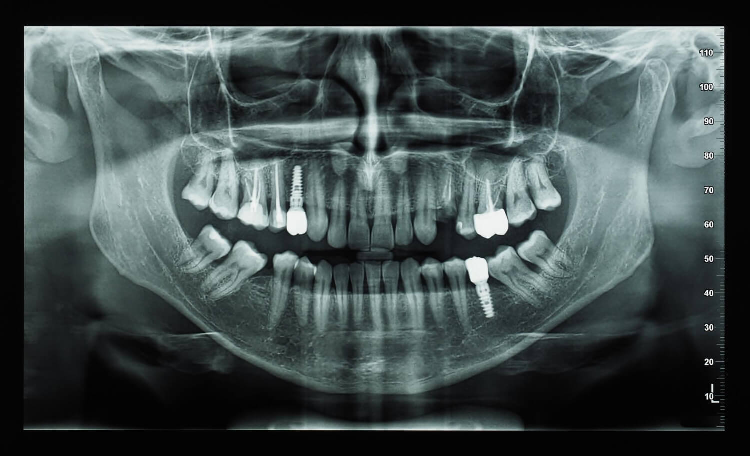 Для чего нужен панорамный снимок зубов?