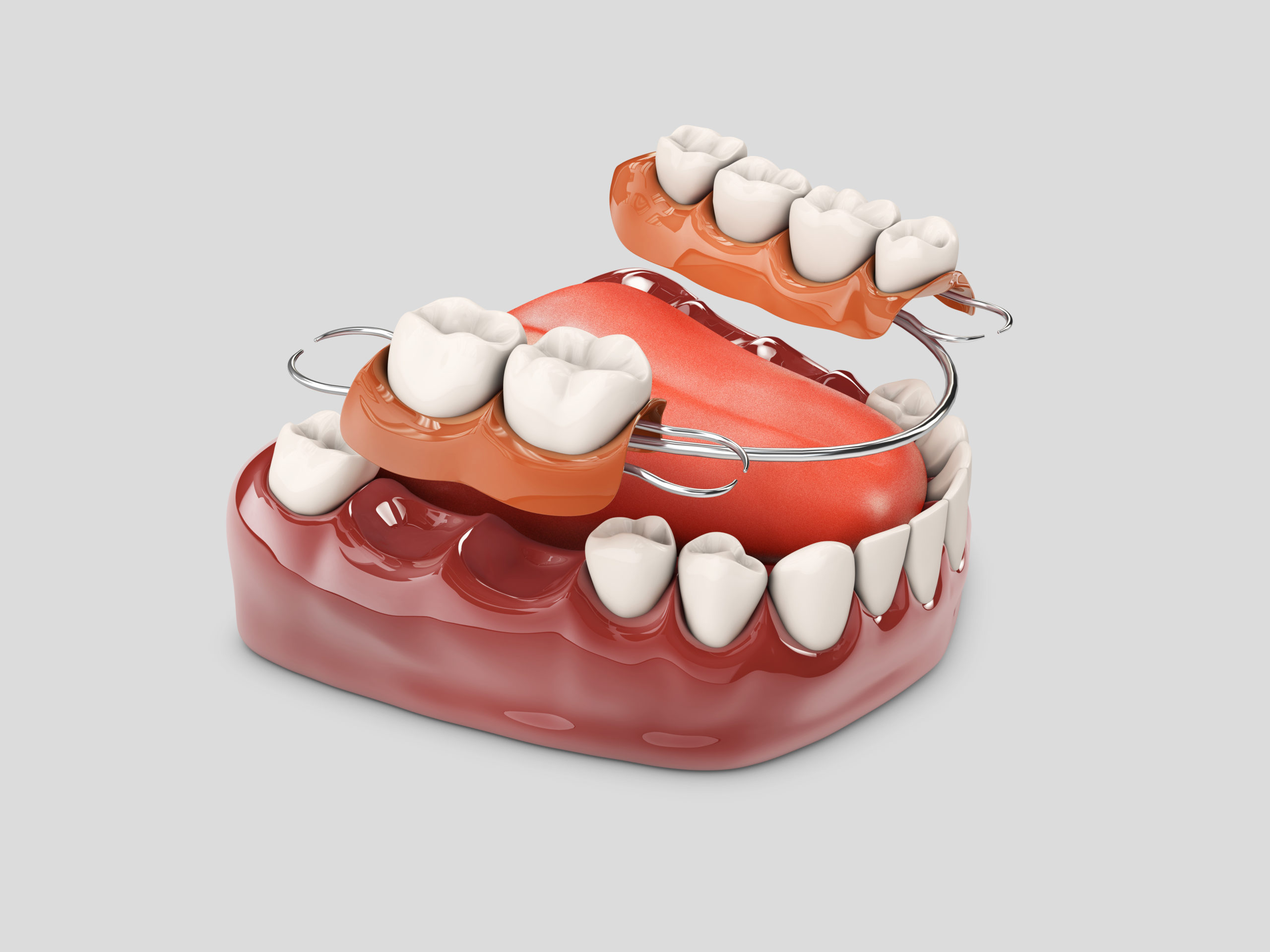 Зубные мосты или импланты – плюсы и минусы современного протезирования