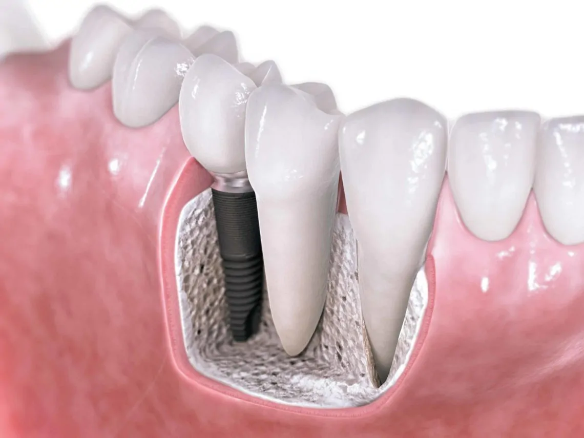 Одноэтапная имплантация зубов: плюсы и особенности методики