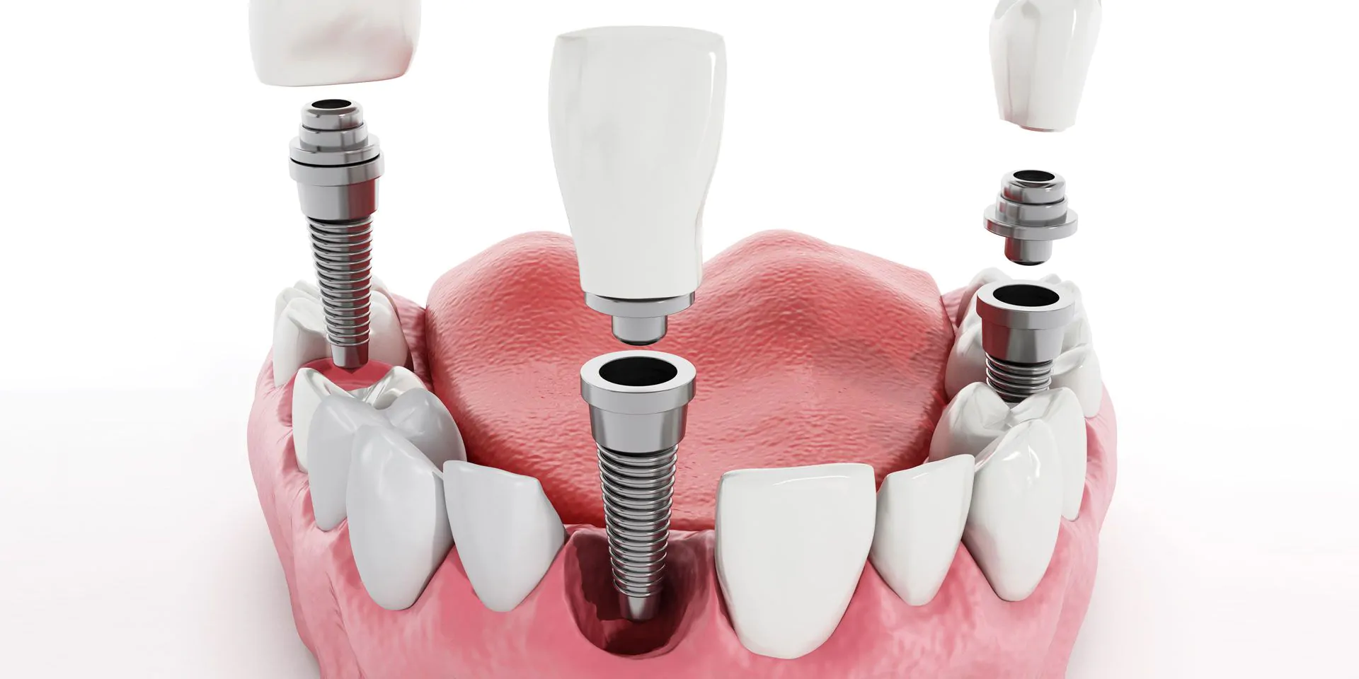 Одноэтапная имплантация зубов: плюсы и особенности методики