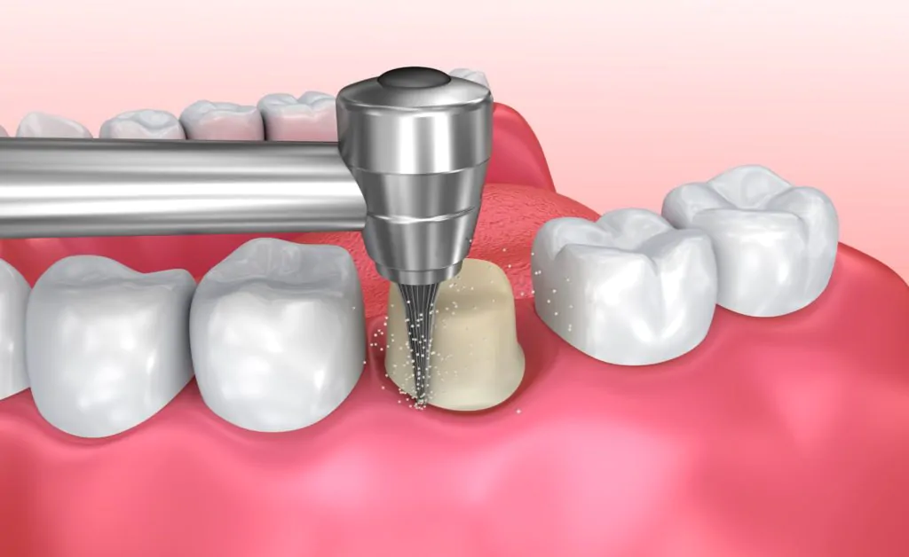 Процедура снятия слепков зубов: видео с подробным описанием каждого этапа