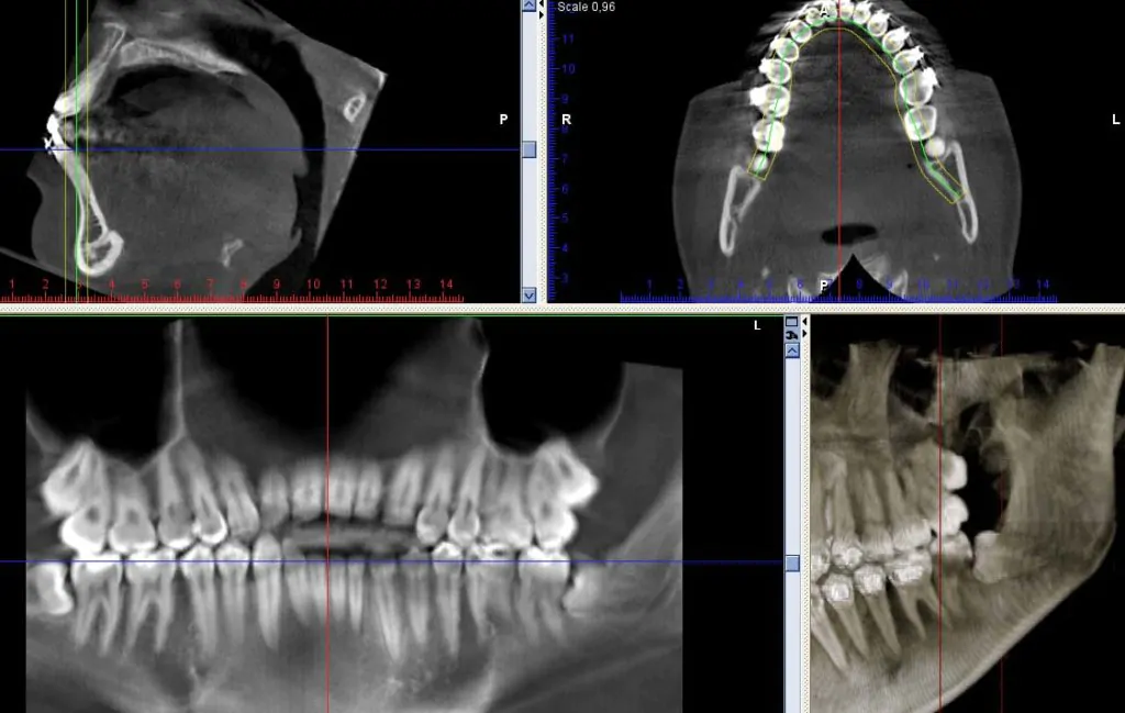 Дистопированный ретированный зуб