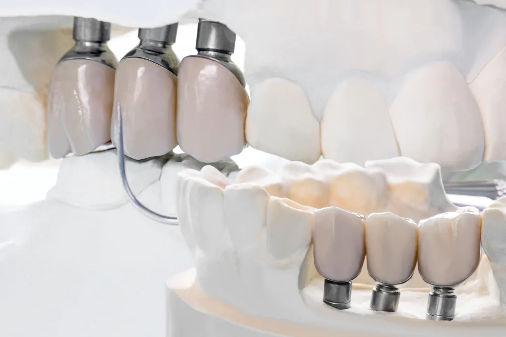 Традиционный способ восстановления зубов в стоматологии – протезирование металлокерамикой