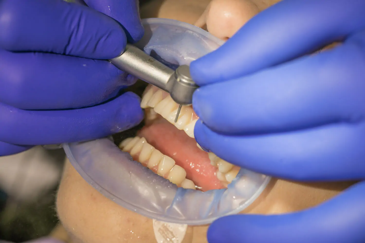 Реставрация передних зубов: варианты и материалы