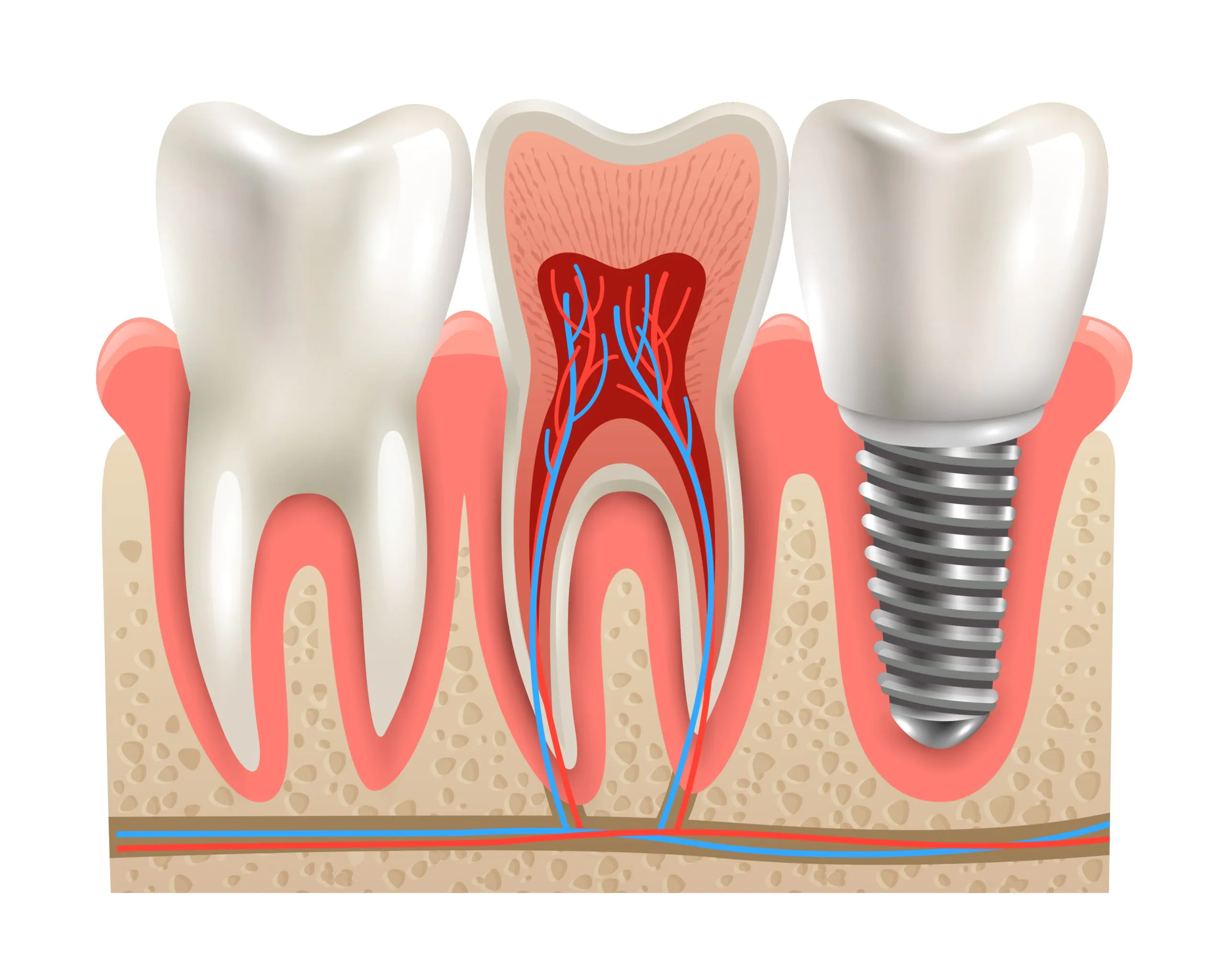 Зубные мосты или импланты – плюсы и минусы современного протезирования