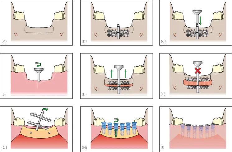 Методы наращивания костной ткани для последующей имплантации