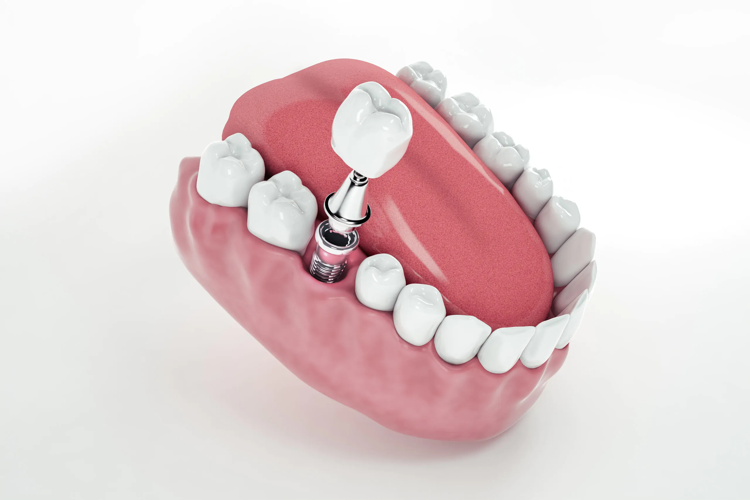 Какой способ восстановления зубного ряда лучше – протезирование или имплантация